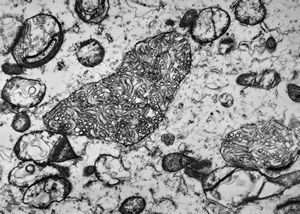 F,44y. | ependymoma F,44y. | ependymoma